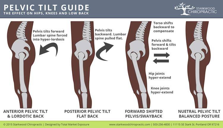 Pelvic Tilt Diagram